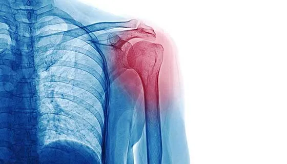 Shoulder Joint Problem treatment image 1
